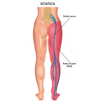 person with sciatic pain in charleston sc